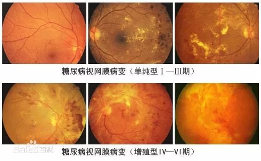 糖尿病视网膜病变成隐形“致盲杀手” 专家称应及时筛查、尽早防治